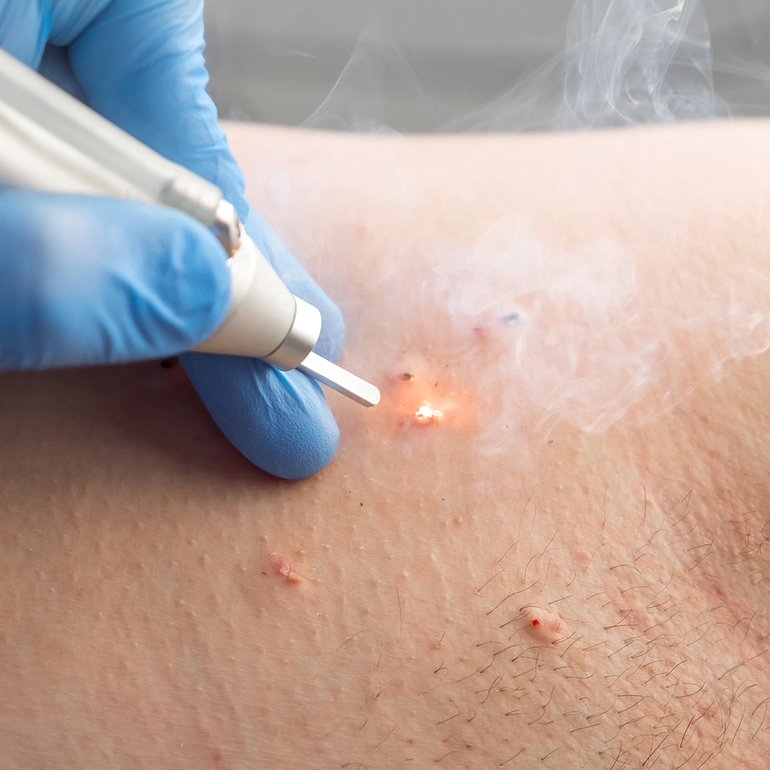 Kondilom Koterizasyonu