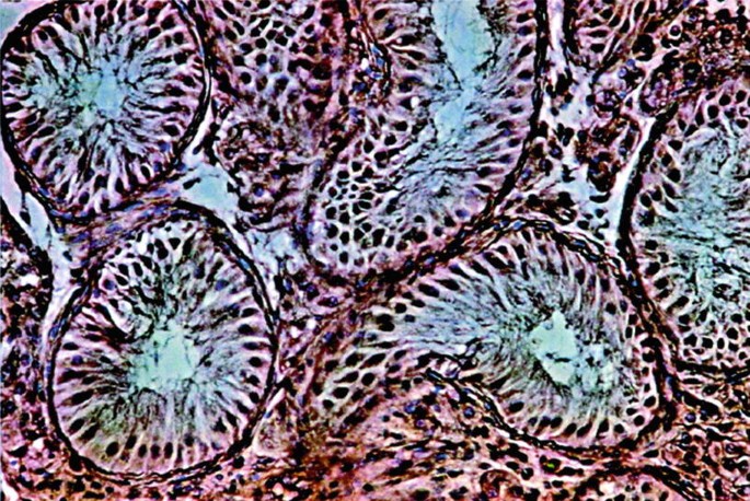 Sertoli Cell Only Sendromu Nedir?